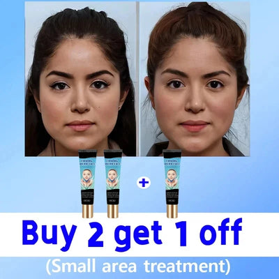 Double Chin V Shape Remove The face fat - LKBA