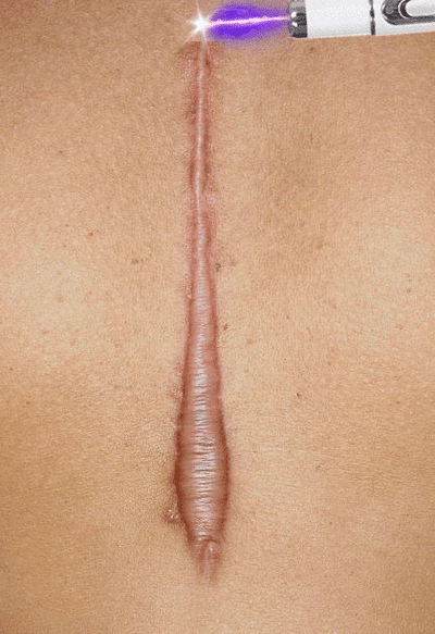 Laser Therapy Keloid Scar Improve Keloid Scar Pen Scar Relief Easy Harmless Laser Pointer - LKBA