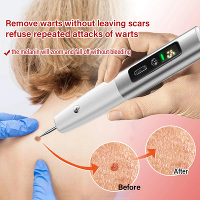 Laser Plasma Pen Black Dots Warts Remover Skin Tag Remover Mole Wart Eliminator Dark Spots - LKBA