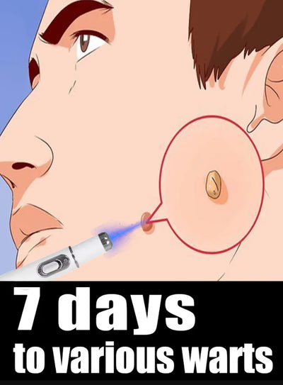 Outil Wart Blue Light, plus de réductions sur les ensembles - LKBA