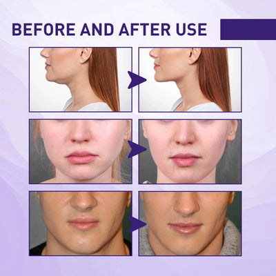 Double Chin V Shape Remove The face fat - LKBA