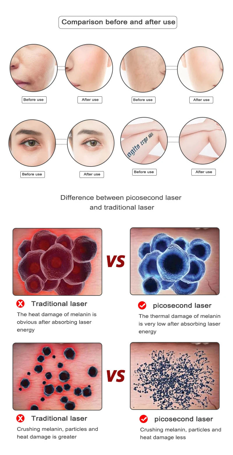 Picosecond Laser Pointer for Mole Removal  Dark Spot Removal Pen Tattoo Acne Skin Pigment Portable Removal Machine Beauty Device - LKBA