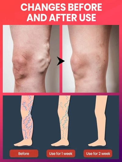 Reverse leg health in 7 days and say goodbye to varicose vein recurrence - LKBA
