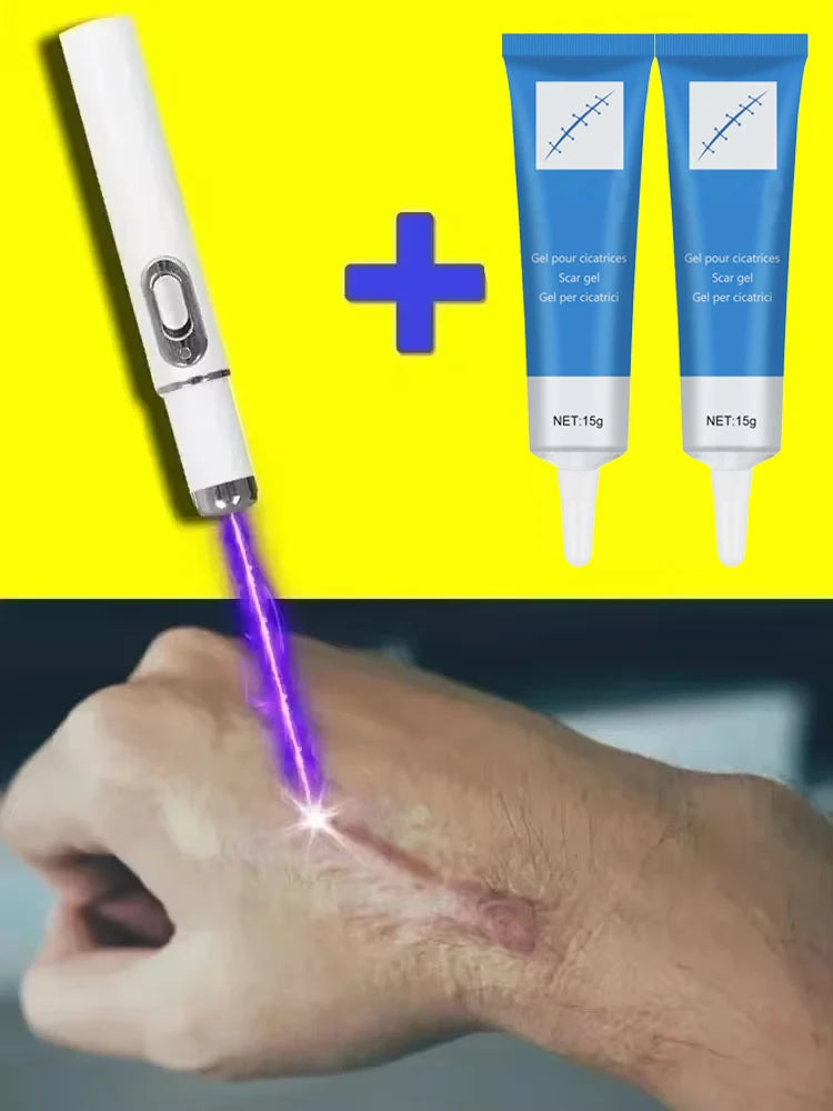 Laser Therapy Keloid Scar Improve Keloid Scar Pen Scar Relief Easy Harmless Laser Pointer - LKBA