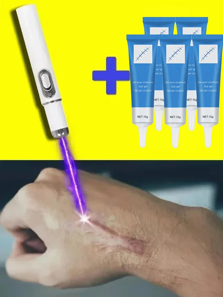Laser Therapy Keloid Scar Improve Keloid Scar Pen Scar Relief Easy Harmless Laser Pointer - LKBA