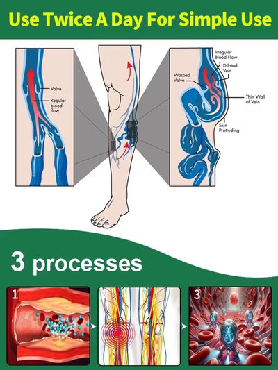 Reverse leg health in 7 days and say goodbye to varicose vein recurrence - LKBA