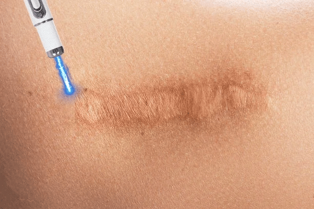 Laser Therapy Keloid Scar Improve Keloid Scar Pen Scar Relief Easy Harmless Laser Pointer - LKBA