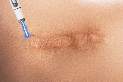 Laser Therapy Keloid Scar Improve Keloid Scar Pen Scar Relief Easy Harmless Laser Pointer - LKBA