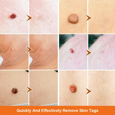 Laser Plasma Pen Black Dots Warts Remover Skin Tag Remover Mole Wart Eliminator Dark Spots - LKBA