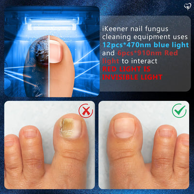 Laser for Nail Fungus Multiple Toenail 905nm470nm 7Minutes Painless Removes Calcium Nail Fungus&Ingrown toenail treatment - LKBA