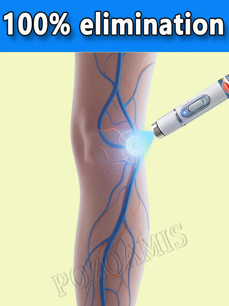 Body care, leg care tools, blue light pen, varicose veins, hot sale in 2025 - LKBA