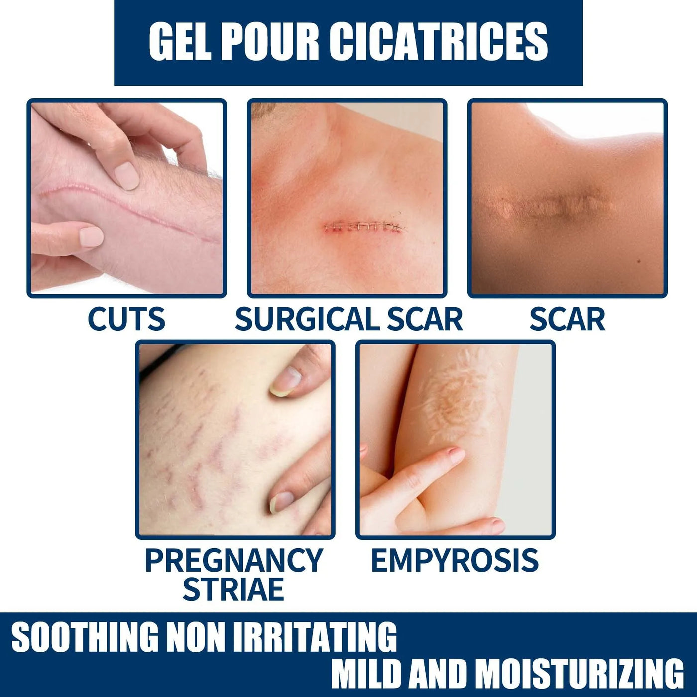 Laser Therapy Keloid Scar Improve Keloid Scar Pen Scar Relief Easy Harmless Laser Pointer - LKBA