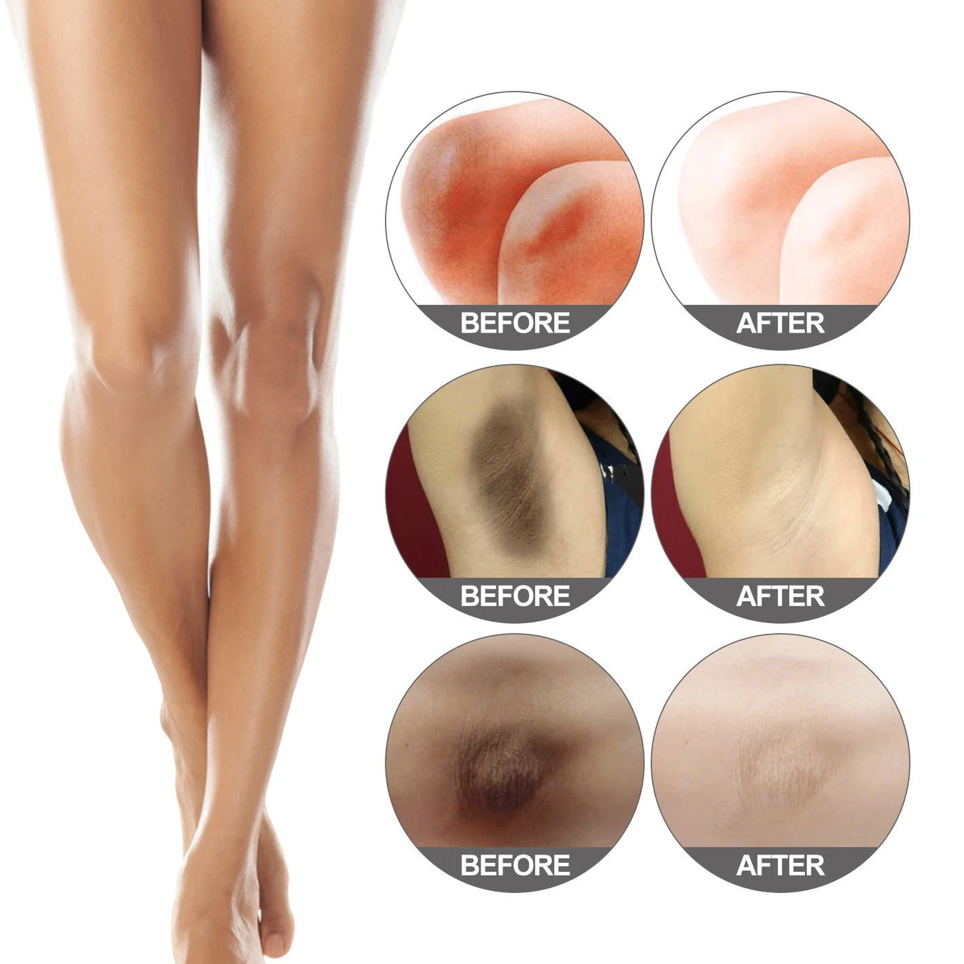 Whitening Cream Private Parts Underarm Bleaching Butt Knee Brighten Inner Thigh Intimate Parts Dark Remove Melanin Fine Skin - LKBA