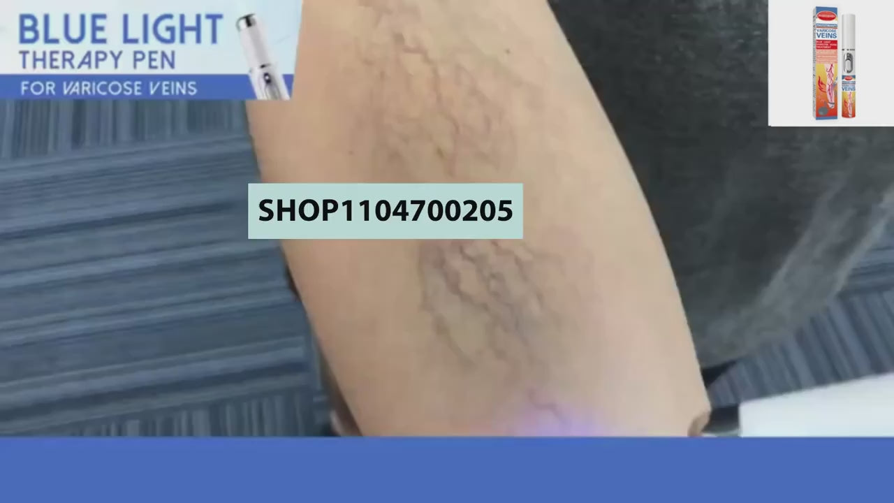 Reverse leg health in 7 days and say goodbye to varicose vein recurrence