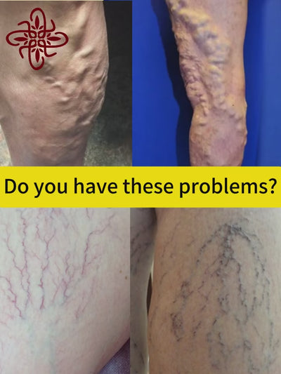 Body care, leg care tools, blue light pen, varicose veins, hot sale in 2025